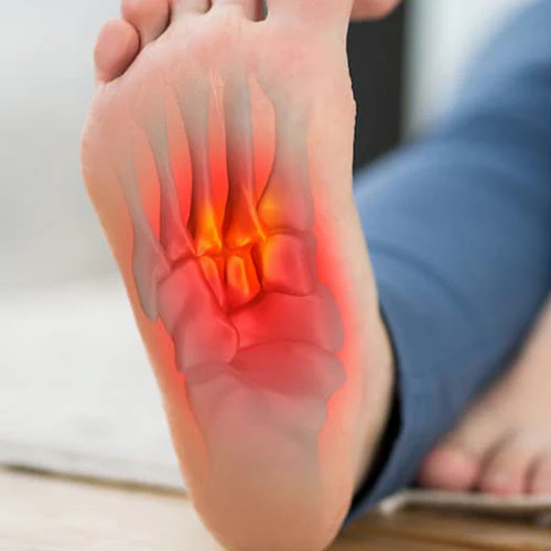 plantar fasciitis